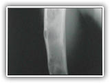 Fibrous dysplasia-humerus-014