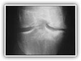 Hemophilia knee-055