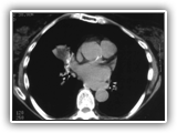 Lipoid pneumonia-006