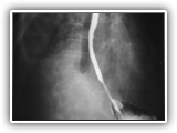 Lye stricture-esophagus