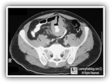 Lymphoma-small bowel-075