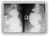 Neurofibromatosis-003