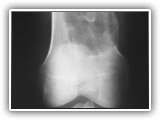 Non-ossifying fibroma-031