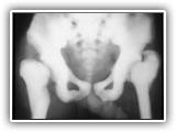 Osteopetrosis-pelvis-AP-028
