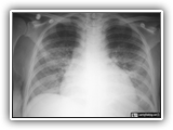 Pneumocystis pneumonia-043