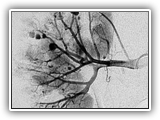 Polyarteritis-kidney-030