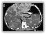 Adult polycystic disease-020