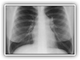 Pulmonic stenosis-037