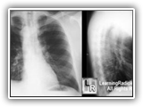 Right aortic arch-001