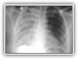 Re-expansion pulmonary edema-019