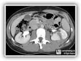 Renal laceration-086