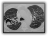 Sarcoid with aspergilloma-002