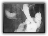 Scleroderma-bowel