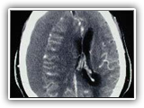 Subdural hematoma-005