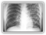 Tuberculosis-053