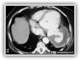 Ventricular aneurysm-057