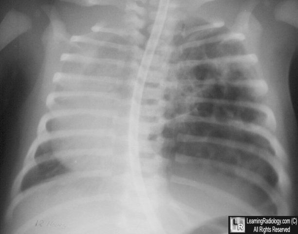 Cystic Adenomatoid Malformation