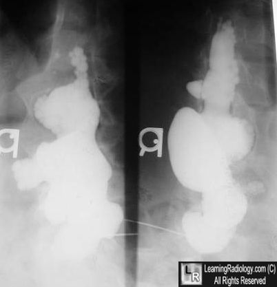 Neurofibromatosis