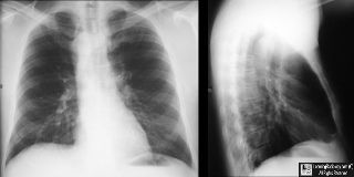 Right aortic arch-LSCA