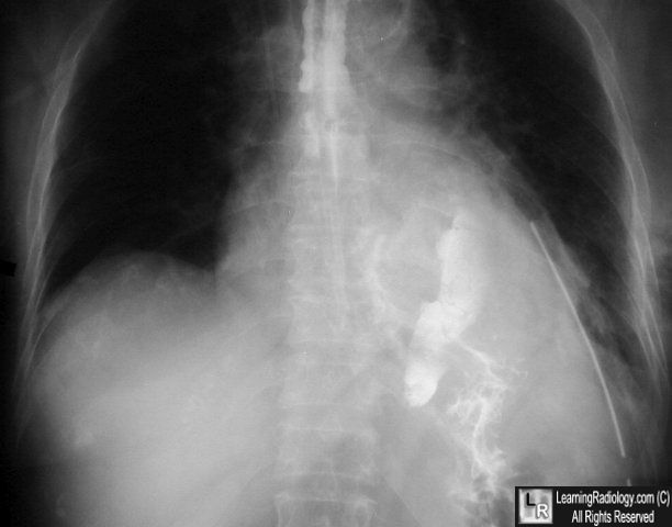 Boerhaave's Syndrome