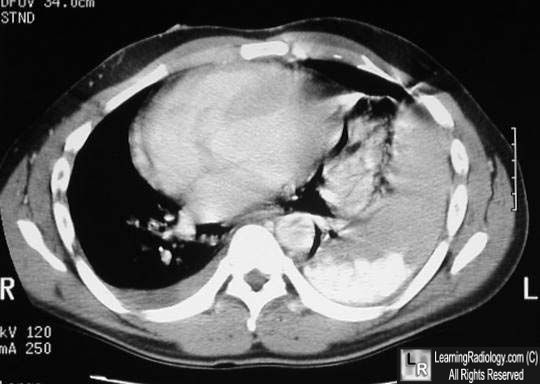 Boerhaave's Syndrome