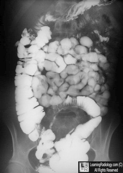 Crohn's Disease