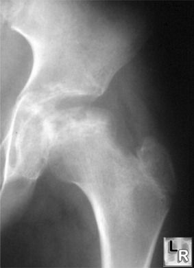 Legg-Calve-Perthe's Disease