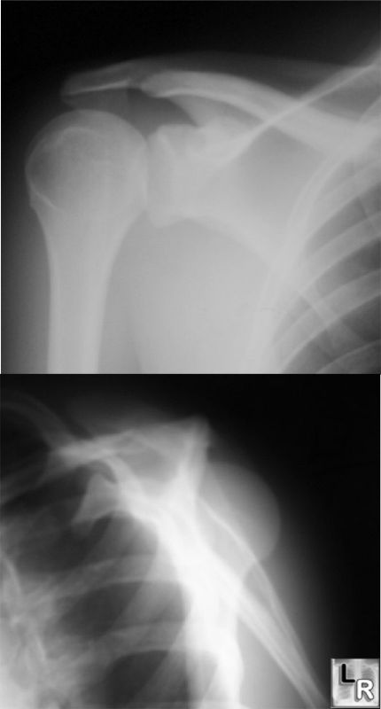 Posterior Dislocation