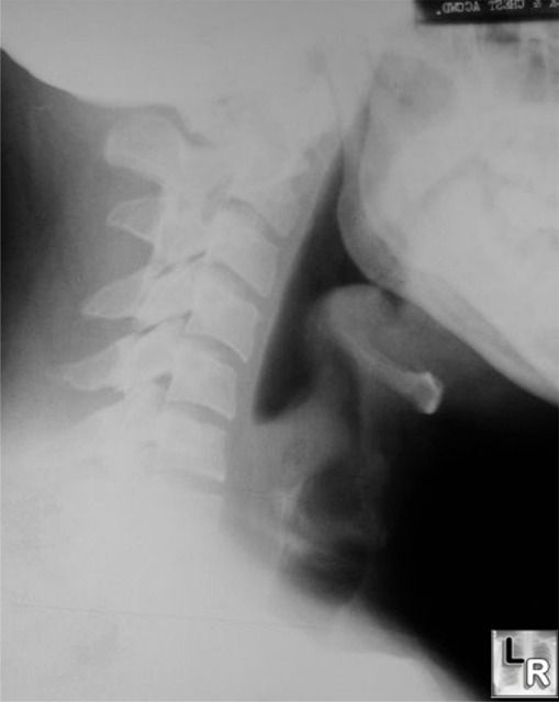 Epiglottotis