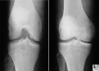 Osteochondritis dissecans