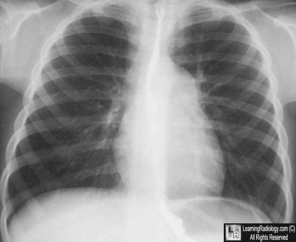 Pulmonic stenosis