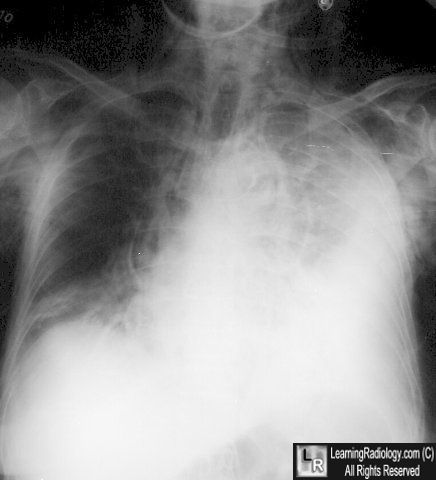 Boerhaave's Syndrome