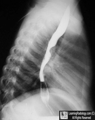 Pulmonary sling