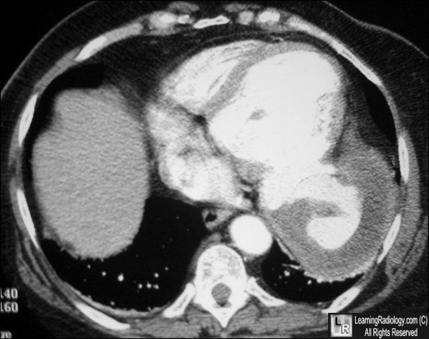 Ventricular aneurysm