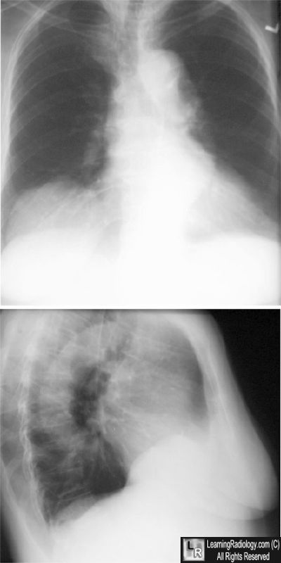 Eventration of diaphragm