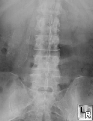 Porcelain gallbladder