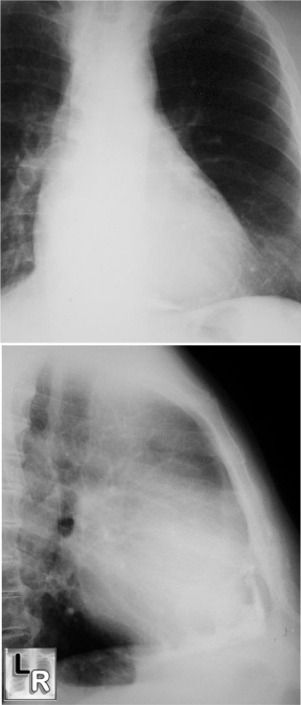 Centrictive Pericarditis