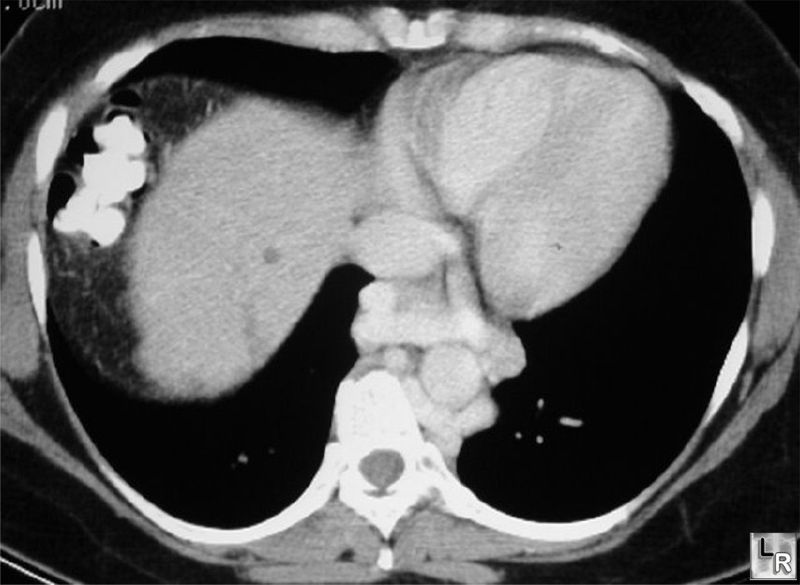 Esophageal varices