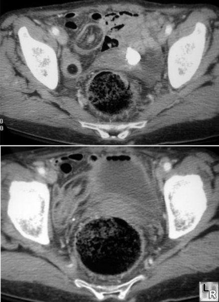 Intussusception