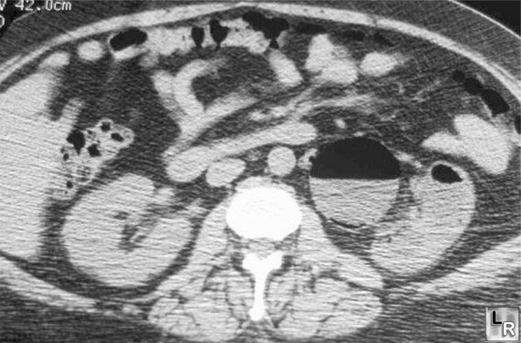 Emphysematous pyelonephritis