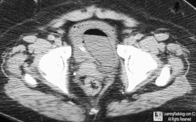 Emphysematous pyelonephritis