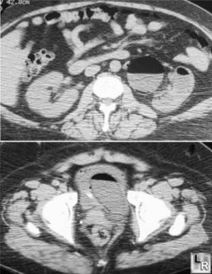 Emphysematous pyelonephritis