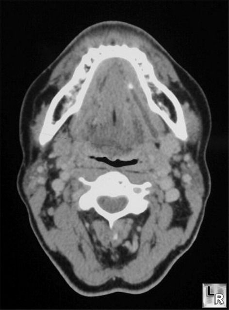 Salivary gland stone