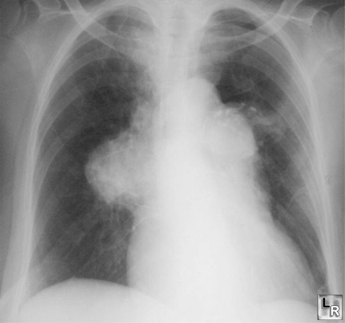 Pulmoanry artery hypertension