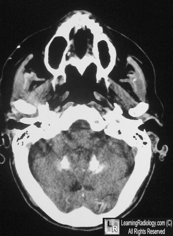 Fahr's disease