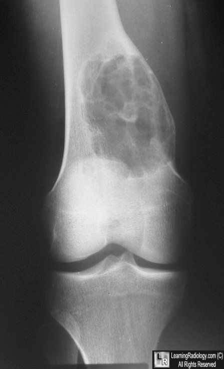 Non-ossifying fibroma