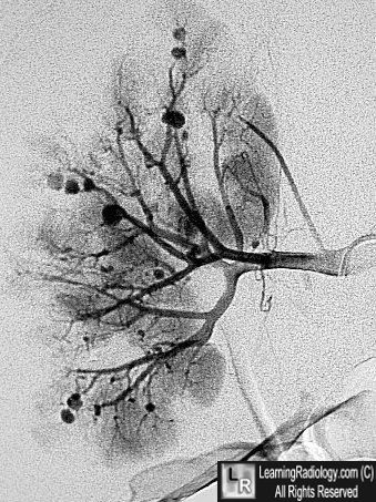 Polyarteritis-kidney