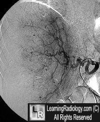 Polyarteritis-liver