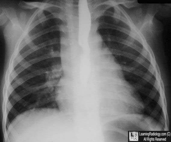 Pulmonary sling