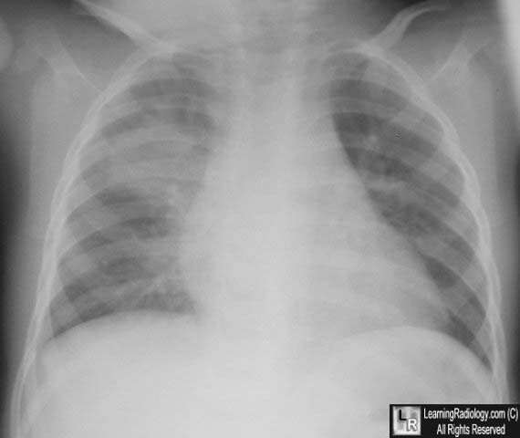 Round pneumonia